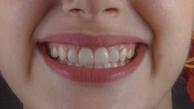 Does Teeth Whitening Work for Everyone?