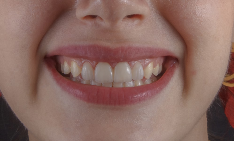 Does Teeth Whitening Work for Everyone?